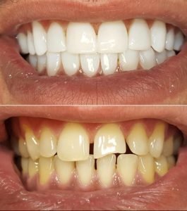 Before-after-facings-smile boutique rotterdam-Ra'ed Althamer