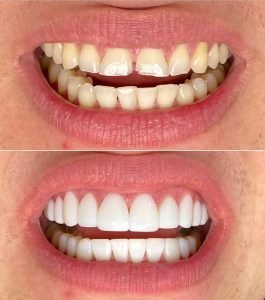 BEFORE AND AFTER COMPOSIET FACINGS TANDARTS RA'ED ALTHAMER SMILE BOUTIQUE ROTTERDAM