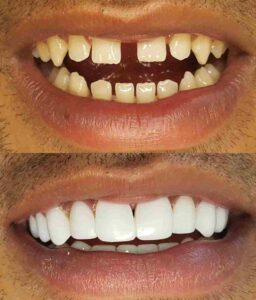 Facings before after 1