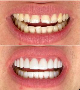 Facings before after voor SB mail3