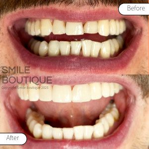 Smile Boutique 2025_Facings_before-after_2_copyright
