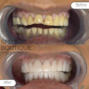 Smile Boutique 2025_Facings_before-after_3_copyright