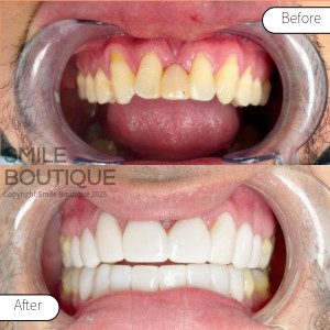 Smile Boutique 2025_Facings_before-after_4_copyright