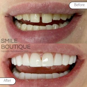 Composietfacings Smile Boutique before and after 5_2025